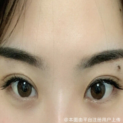 埋线双眼皮