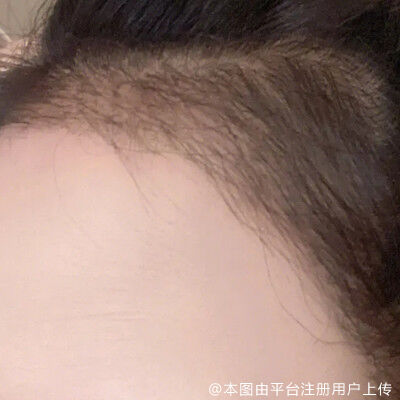 发际线种植