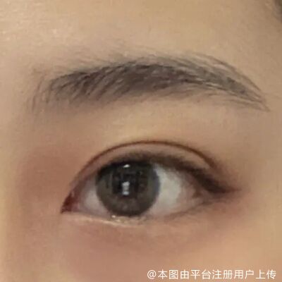 切开双眼皮