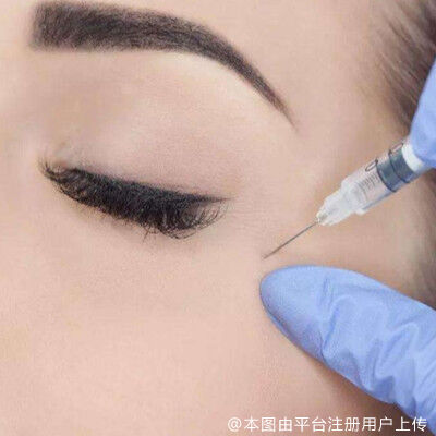 注射去鱼尾纹