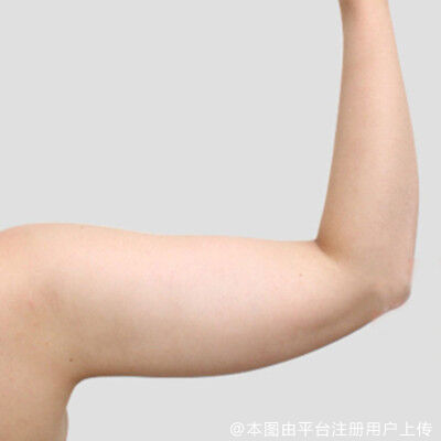 射频溶脂瘦手臂