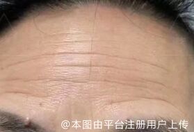 玻尿酸去静态纹