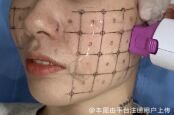 热玛吉