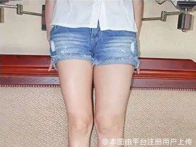 吸脂瘦大腿