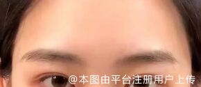 假体丰太阳穴