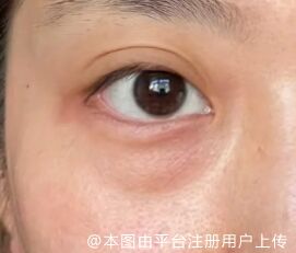 玻尿酸丰泪沟