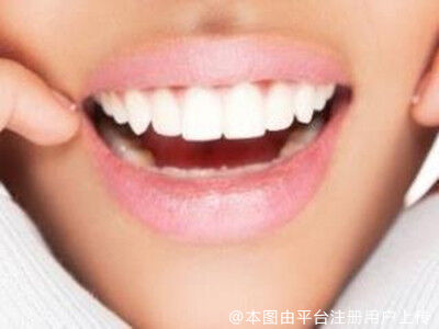 皓齿美白