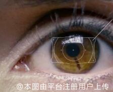 晶体植入手术
