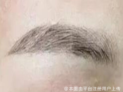 眉毛种植