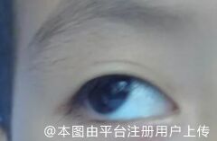 斜视矫正