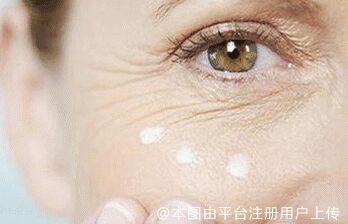 注射去动态纹