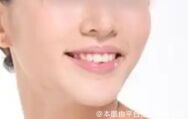 假体丰下巴